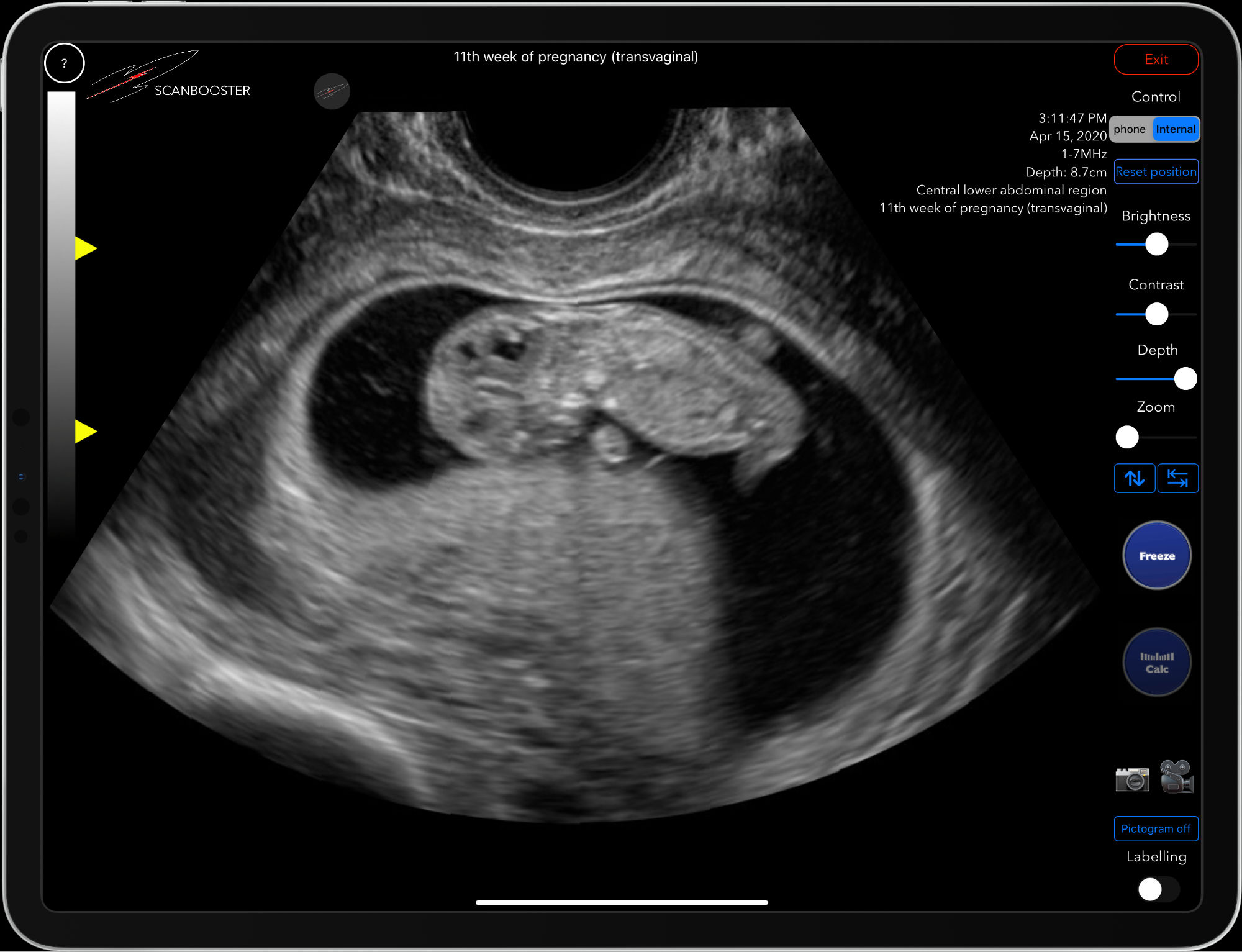 Scanbooster intravaginal transvaginal intracavity ultrasound probe simulation 11th week of pregnancy sonography in gynecology
