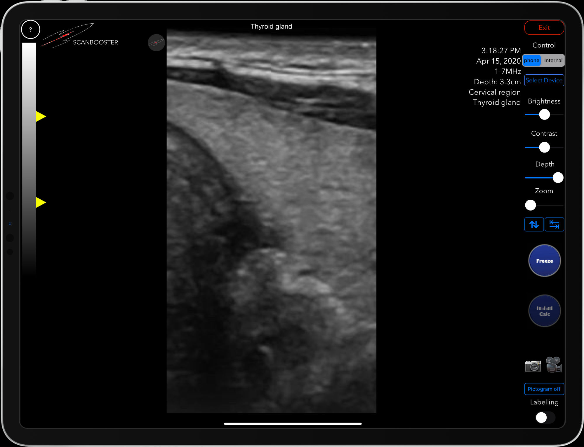 Scanbooster linear ultrasound probe simulation thyroid gland sonography in internal medicine Schilddrüsenultraschall in der inneren Medizin Linearschallkopf
