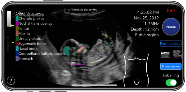 Simulate sonography remotely on an iPhone smartphone - learn kidney ultrasound focus, gyn, urology, obstetrics, internal medicine ultrasound
