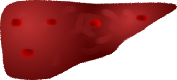 Liver metastasis due to breast cancer metastatic liver sonographic ultrasound image simulation Scanbooster