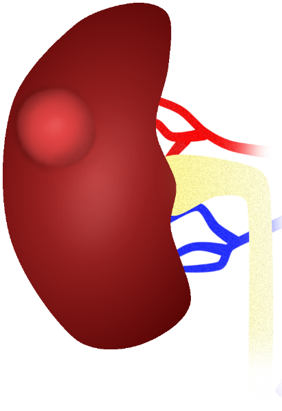Renal cyst kidney cyst sonographic ultrasound image simulation Scanbooster