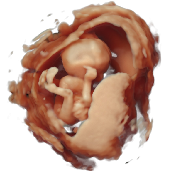 Body stalk anomaly sonographic ultrasound image simulation Scanbooster