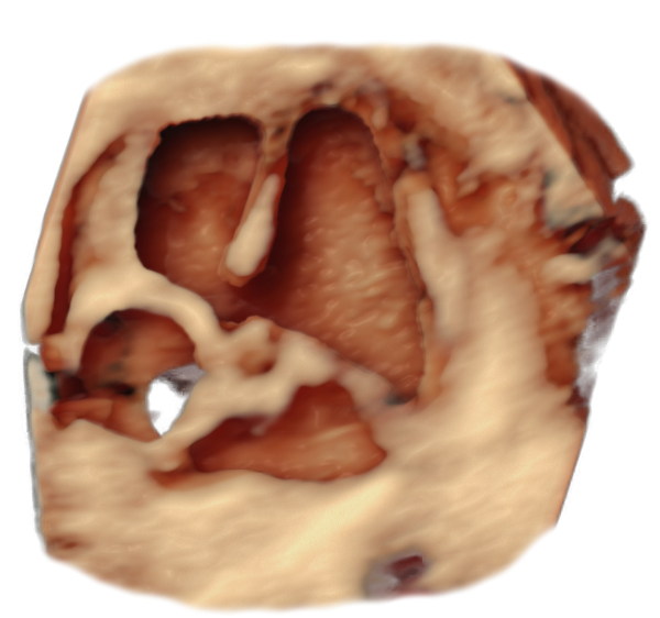 Tetralogy of Fallot intrauterine sonographic ultrasound image simulation Scanbooster