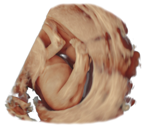 Sirenomelia mermaid syndrome sonographic ultrasound image simulation Scanbooster